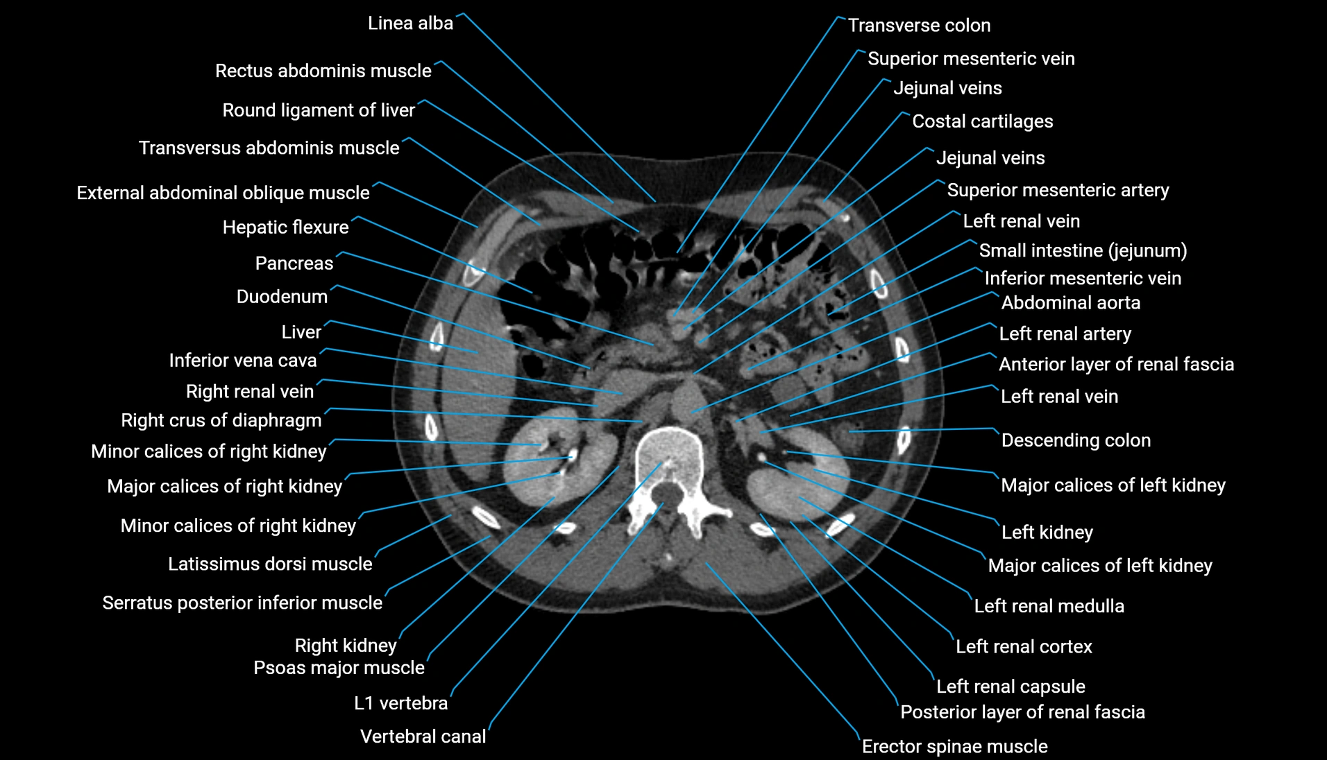 CT urogram axial cross sectional anatomy  labelled radiology image-00096.webp